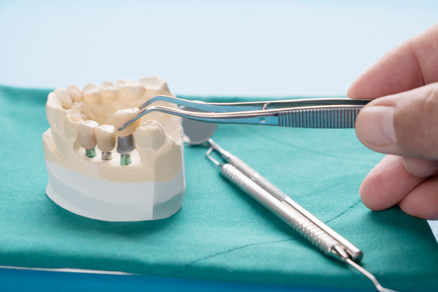 implantes dentales en adeje